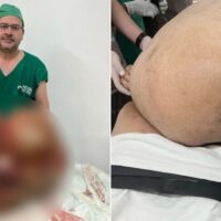 Tumor de 46kg retirado de paciente no Rio de Janeiro se torna recorde mundial