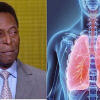 Pelé quebra silêncio após internação: ele luta contra um câncer e a quimioterapia não tem surtido efeito